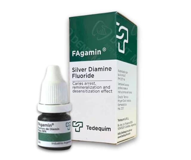 Điều trị và ngừa sâu răng trẻ em bằng SDF (Silver Diamine Fluoride)